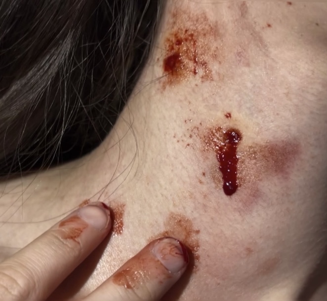 Mordida de vampiro