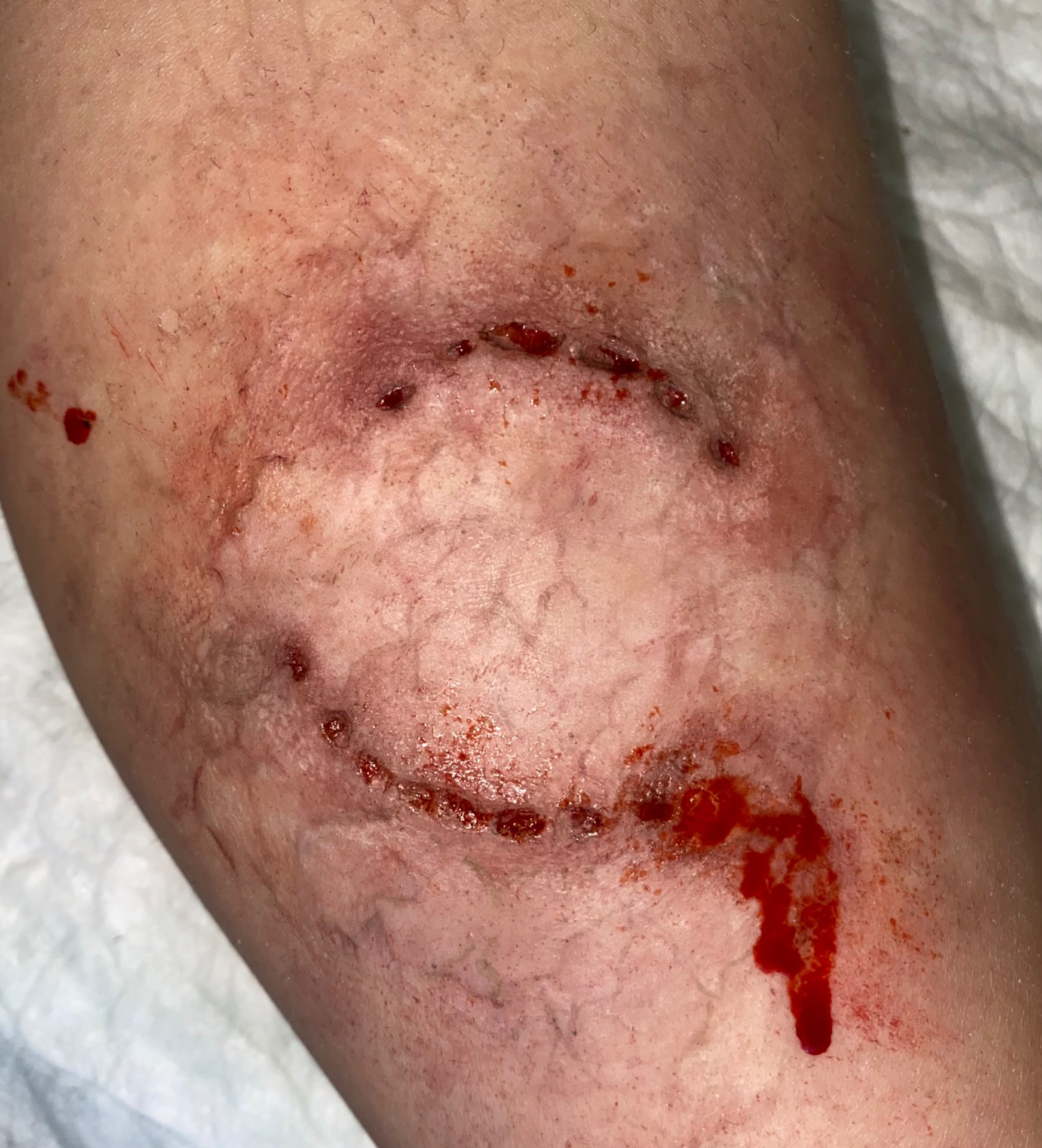 Mordida zombie infectada