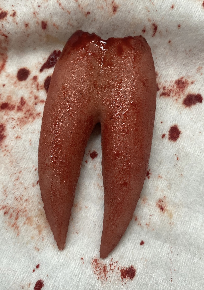 Lengua bífida